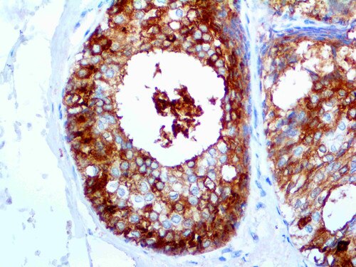 IHC of GCDFP-15 on an FFPE Breast Carcinoma Tissue